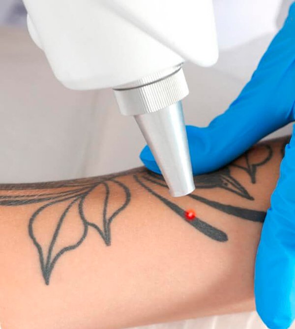 Borrar tatuajes en Rosario