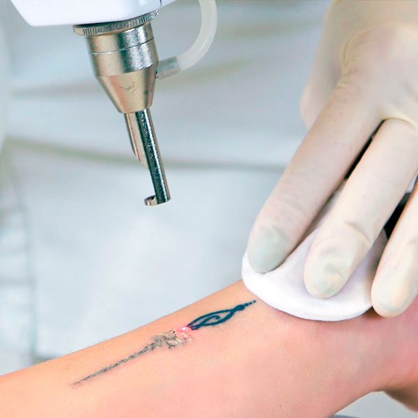 Borrar Tatuajes Rosario