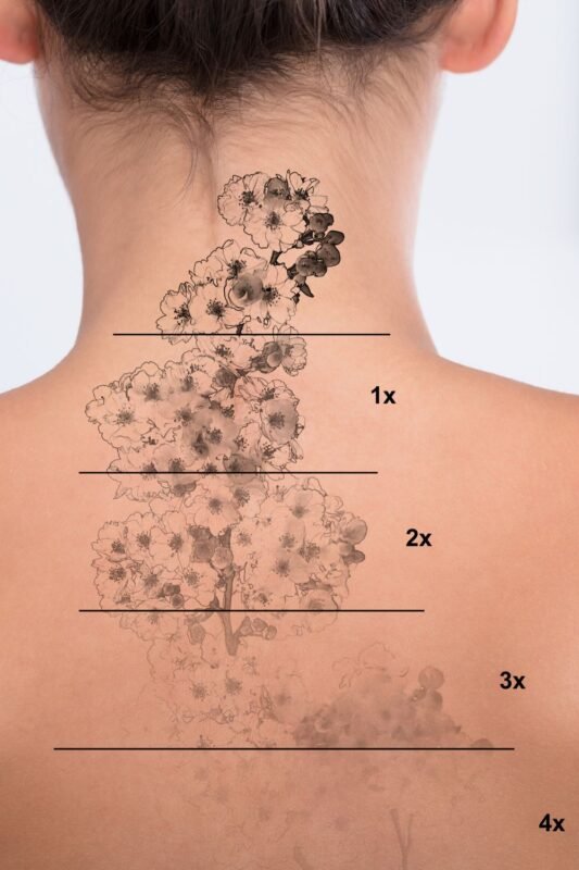 Remoción de tatuajes Rosario